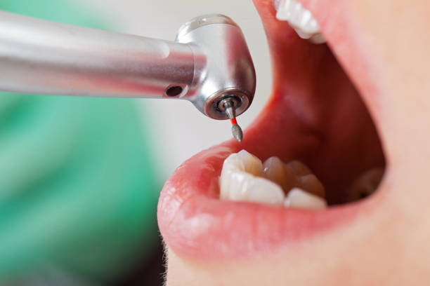 Best Emergency Wisdom Teeth Removal in Marshall, MN